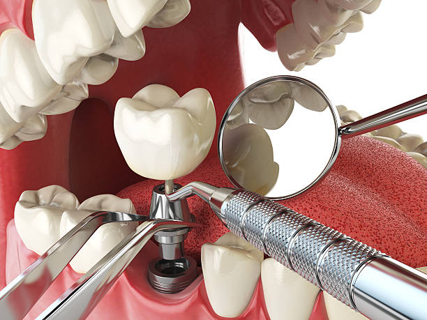 Best Emergency Cosmetic Dentistry (e.g., broken veneers) in Buenaventura Lakes, FL